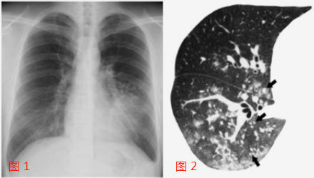 支原体肺炎症状及表现