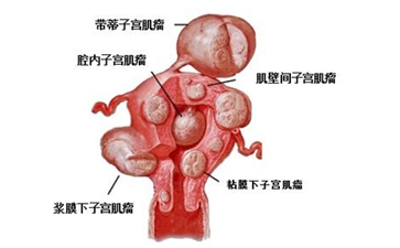 肌壁间子宫肌瘤症状