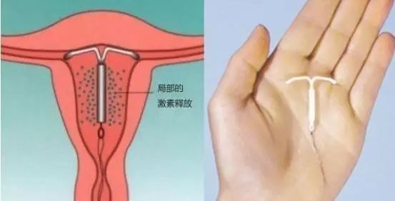 女生取环后多久可以怀孕