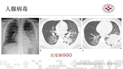 得甲流一周变成病毒性肺炎